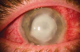 Your Corneal Infection Care Questions Answered