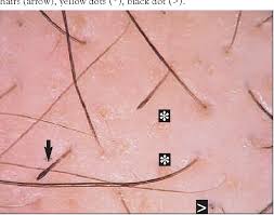 If the clogged pore is open and exposed to the air, the spot will turn black because of oxidization. Figure 5 From Trichoscopy A New Method For Diagnosing Hair Loss Semantic Scholar