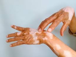 Image result for Vitiligo