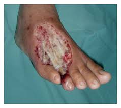 Sometimes eschar becomes very tight and constricting in a burned area. Wound Bed Preparation For Chronic Diabetic Foot Ulcers