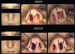 Nasal Growth after Pediatric Septoplasty at Long-term Follow-up