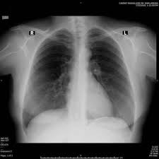 Ești o femeie sau bărbat în zonele în care apar cel mai des fracturile declanșate de prezența osteoporozei în corp sunt acelea de la şold, încheietura mâinii sau cele de la. Bristol Med Radiologie Ploiesti PostÄƒri Facebook