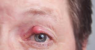 What Is Eye Herpes Symptoms Treatment Complications