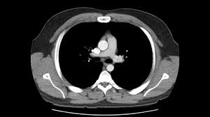 The muscles of the back﻿ are a group of strong, paired muscles that lie on the posterior aspect of the trunk. Anatomy Of Ct Scans Thoracic Cavity Youtube