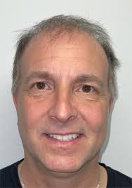 Hair Transplant Surgery For Men And Women in Maryland Harford Coldstream