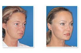 Dr T. William Evans DDS MD Columbus Cosmetic Surgeon