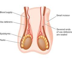 World vasectomy day is coming up on november 17. Vasectomy Tijuana Mexico Unidad De Urologia