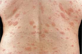 However, pityriasis rosea often leaves behind patches of lighter. Pityriasis Rosea Amboss