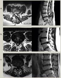 Cauda equina syndrome (ces) is a particularly serious type of nerve root problem. Cauda Equina Syndrome Principles Of Management Orthopaedics And Trauma
