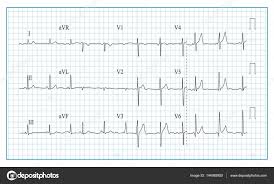 Heart Cardiogram Chart Vector Illustration Of Wave Form On