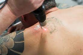 Laser tattoo removal typically does involve some level of pain. Faq Does Laser Tattoo Removal Hurt Andrea Catton Laser Clinic