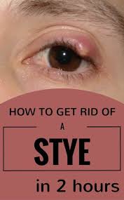 Anyone Confronted With A Stye At Least Once In His Life It S A Painful And Not A Very Pleasant Sensation To Have A Huge Stye Stye Treatment Pimple On Eyelid