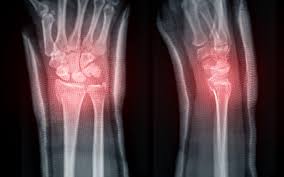 Image result for Wrist XRay