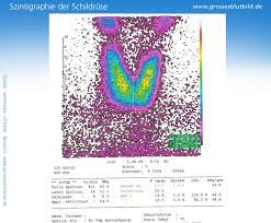 Szintigraphie der schilddrüse ist ein funktionelles diagnostisches verfahren, den grad der sättigung seines gewebes mit radioaktiven isotopen zu bestimmen. Szintigraphie Ablauf Dauer Und Erklarung Der Untersuchung