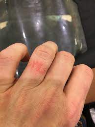 Rose gold that is 14k, 18kt, or higher will contain enough gold to make. 9ct Gold Allergy Mumsnet