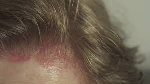 The areas get irritated and swollen immediately after you have used the dye. Allergy On The Scalp After Stock Footage Video 100 Royalty Free 1058574535 Shutterstock