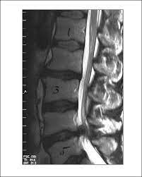 Bandscheibenvorfall Der Lws In Hohe Lwk 4 5 Mit Operation Bandscheibenvorfall De