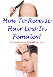 Pin On Hair Loss Awareness