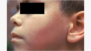 Image result for red rash face