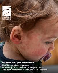 Image result for Measles