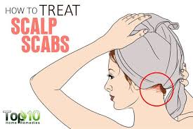 How To Treat Scalp Scabs Top 10 Home Remedies Scalp Scabs Sores On Scalp Home Remedies For Dandruff