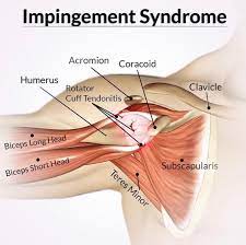 Physioosteobook Impingement Syndrome Shoulder Or Arm Facebook