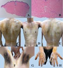 Image result for Anhidrosis