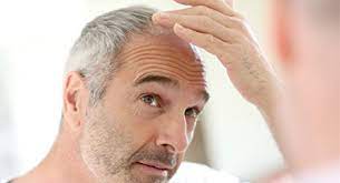 There are a few isolated reports of hair loss related to taking metformin. Does Diabetes Cause Hair Loss