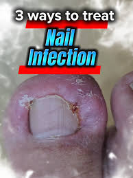 Image result for Paronychia feet