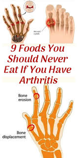 9 Foods You Should Never Eat If You Have Arthritis Arthritis Health Healthy Healthcare Wellness Healthbenefi Arthritis Health Anti Inflammatory Recipes