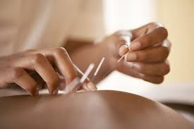 Image result for Acupuncture
