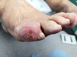 Image result for gout symptoms toe