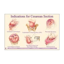 Indications For Cesarean Section Chart Newborn Nursing Midwifery Child Nursing