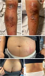 Image result for pruritic urticarial papules and plaques of pregnancy