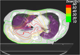 Pneumonitis after normofractionated radioimmunotherapy: a method for  dosimetric evaluation