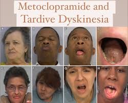 Image result for Extrapyramidal Side Effect