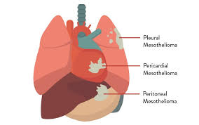 Unfortunately, mesothelioma is aggressive cancer, and the prognosis is poor for most patients. Malignant Pleural Mesothelioma Survival Rate Mesothelioma