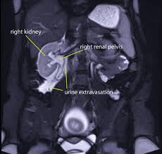 The contemporary management of renal and ureteric calculi. Renal Pelvis Rupture During Pregnancy Diagnosing A Confusing Source Of Despair Bmj Case Reports