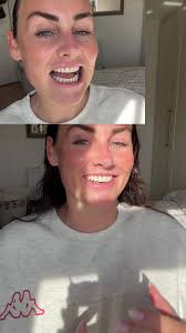 Effective Teeth Whitening with Whites Beaconsfield Strips