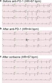 Sick Sinus Syndrome Associated With Anti Programmed Cell Death 1 Journal For Immunotherapy Of Cancer Full Text