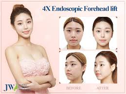 In the frontal area, the . 4x Endoscopic Forehead Lift Jw Korean Plastic Hospital