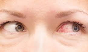 Solutions for puffiness under the eyes varies, and is very much dependant on the severity of your swelling. Red Veins In Eyes Causes And Treatment
