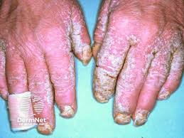 Image result for scabies norvegica
