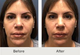 Maybe you would like to learn more about one of these? Under Eye Filler Injections Charlotte Nc Carolina Facial Plastics