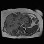 Metastasen bei Brustkrebs, Symptome, Therapie