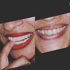 Helps strengthen teeth and fights cavities. How To Save Lots Of Money By Getting Your Teeth Done In Colombia Dental Tourism Colombia Dental Tourism Colombia