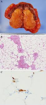 Looking for online definition of renal sinus in the medical dictionary? A Case Of Angiomyolipoma Of The Renal Sinus Springerlink