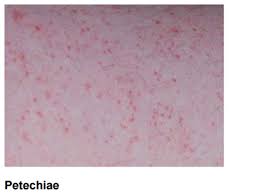 Non Blanching Rash Management In Children