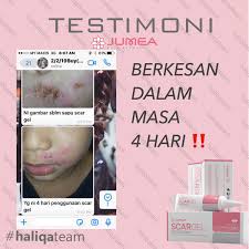 Get rid of acne & acne scar(gadde aur dagh), acnes scar care gel review urdu hindi, in this video, i will show you how you. Wowwaa On Twitter I Wonder Maybe You Haven T Heard Abt Jumea Scar Gel Right Hehheehe Kalau Any Scars Yang Visible Should Try This Product But Kalau Unvisible Punya Scars Yang Merabak Jiwa