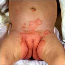 Image result for diaper dermatitis